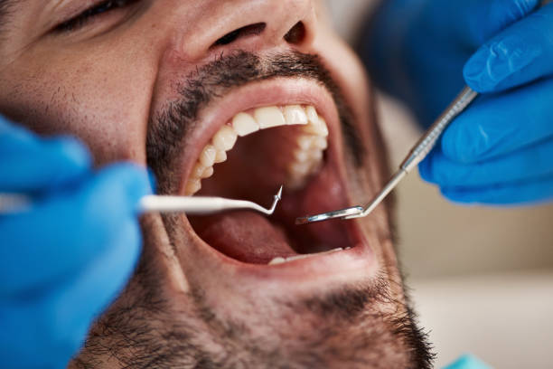 Best Knocked-Out Tooth (Avulsed Tooth) Treatment in Hastings, MN